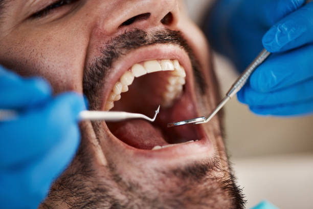 Best Broken or Chipped Tooth Repair in Beaufort, SC